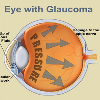 Glaucoma Doctor In Satellite Ahmedabad