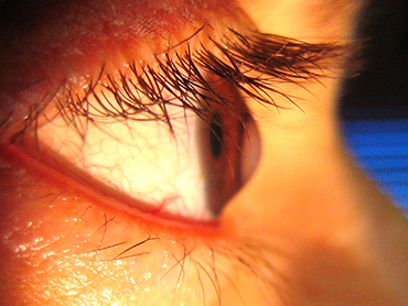 Dr. Tushar V. Bhatt for Eye Surgeon and Eye Specialist In Satellite Ahmedabad. Affordable Eye Surgeon and best eye Treatment from experience Eye Specialist In Satellite Ahmedabad, Eye Surgeon Satellite Ahmedabad